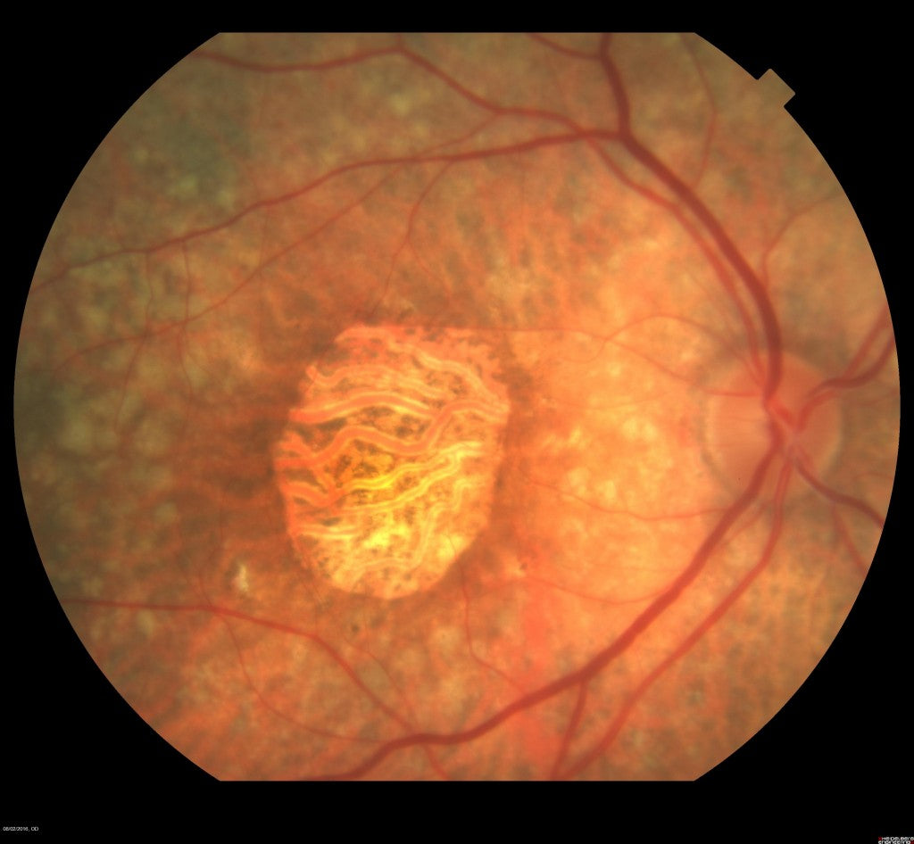 macular retinal atrophy