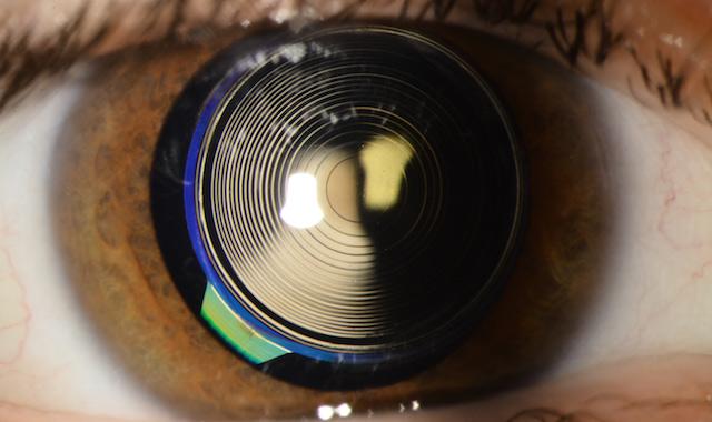 multifocal lens implant