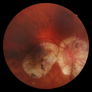 myopic macular degeneration photograph