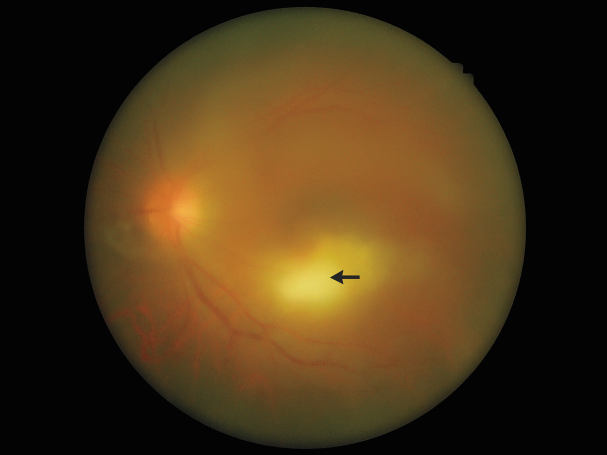 Ocular Toxoplasmosis