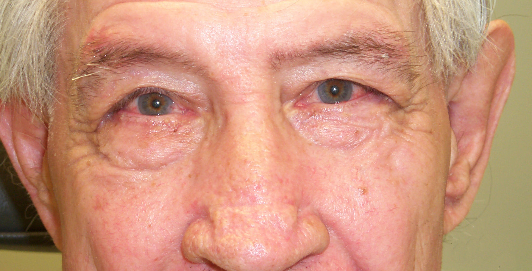 Rosacea causes facial redness and eye irritation that can worsen the symptoms of dry eye.
