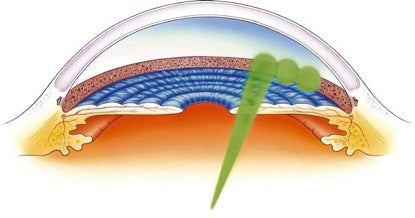 cool laser SLT for glaucoma