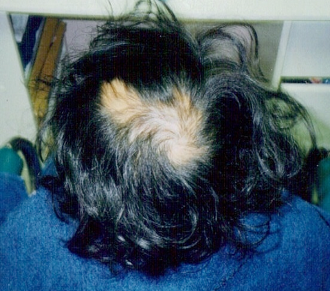 Alopecia Areata patient