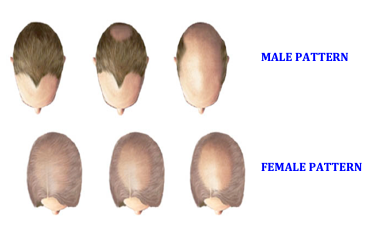 Male Female Pattern Balding