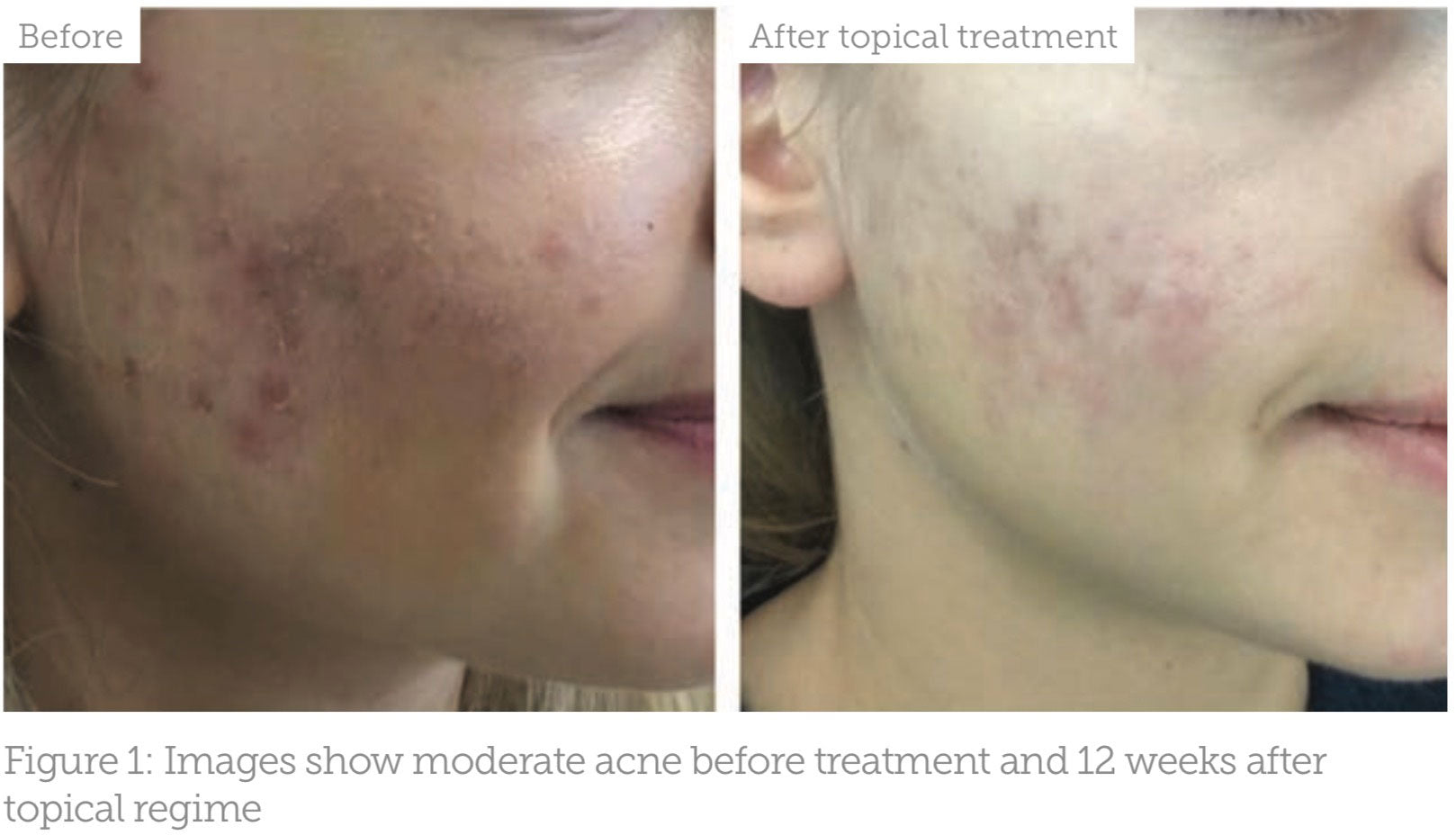 Images show moderate acne before treatment and 12 weeks after topical regime