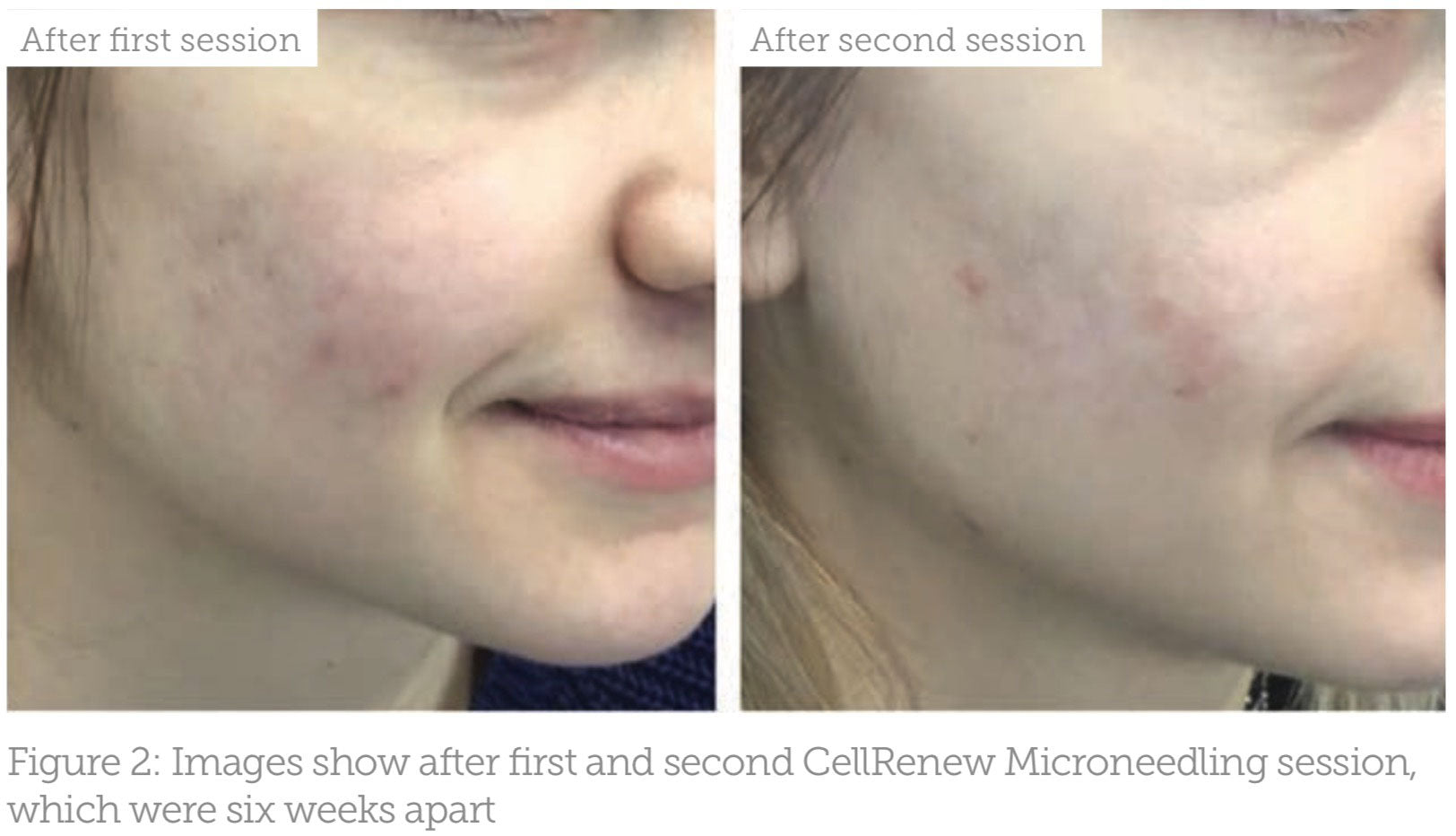 Images show after first and second CellRenew Microneedling session, which were 6 weeks apart