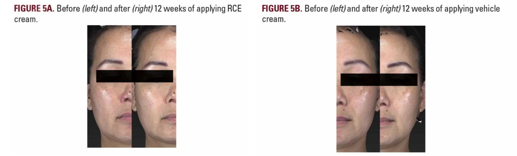 Before & After 12 weeks of applying RCE cream VS applying vehicle cream