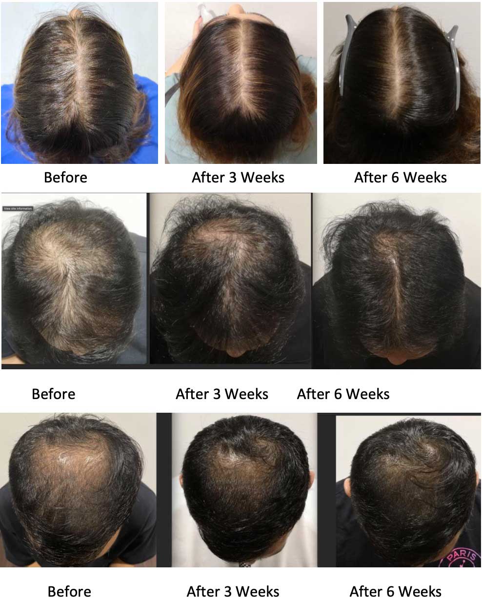 Stem Cell Therapy for Hair Loss Potential and Limitations  Hairverse