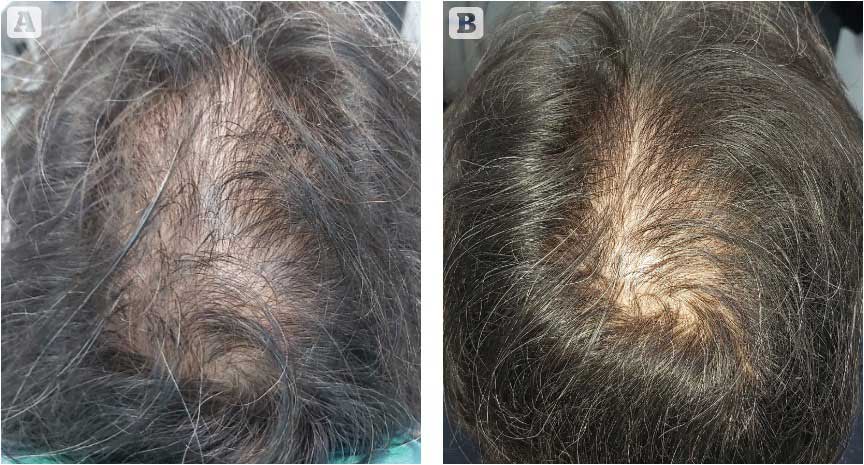 Figure 2 - Patient (A) before and (B) 3 months after treatment with PRP