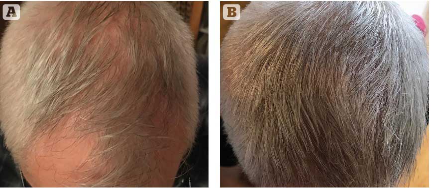 Figure 3 - Patient (A) before and (B) 3 months after Calecim hair microneedling