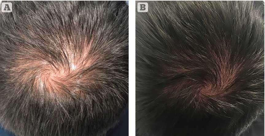 Figure 4 - Patient (A) before and (B) 3 months after Calecim hair microneedling