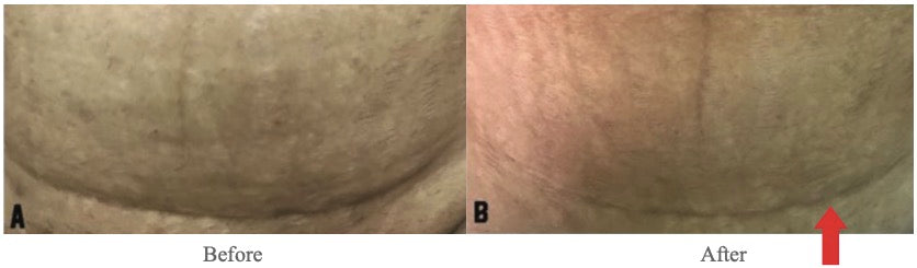 12 weeks after the initial fractional carbon dioxide laser treatment following with application of CLCM shows improvement in hypepigmentation, height and softening of the scar.