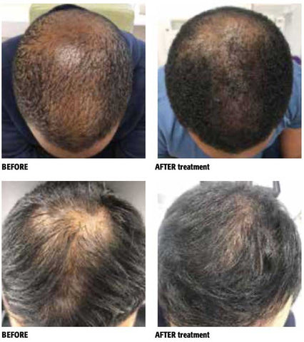 The best stem cell hair treatment to regrow hair quickly – Calecim  Professional
