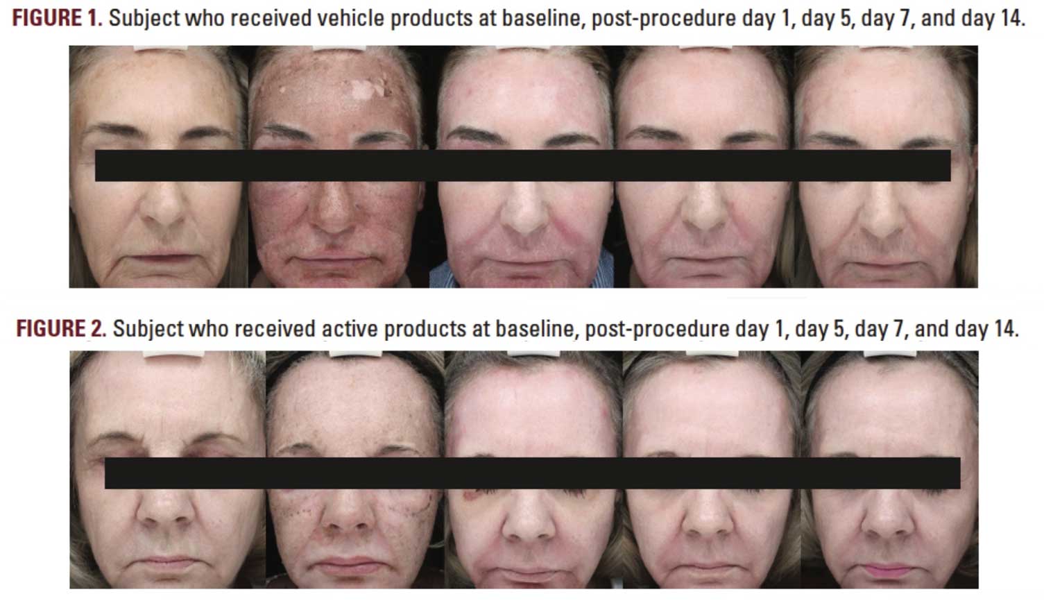 Subject who received vehicle VS active products at baseline, post-procedure day 1, day 5, day 7 and day 14