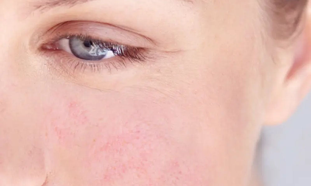 Rosacea