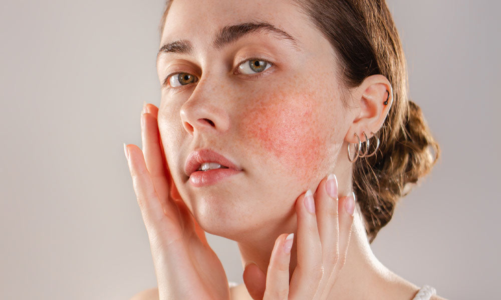 Rosacea