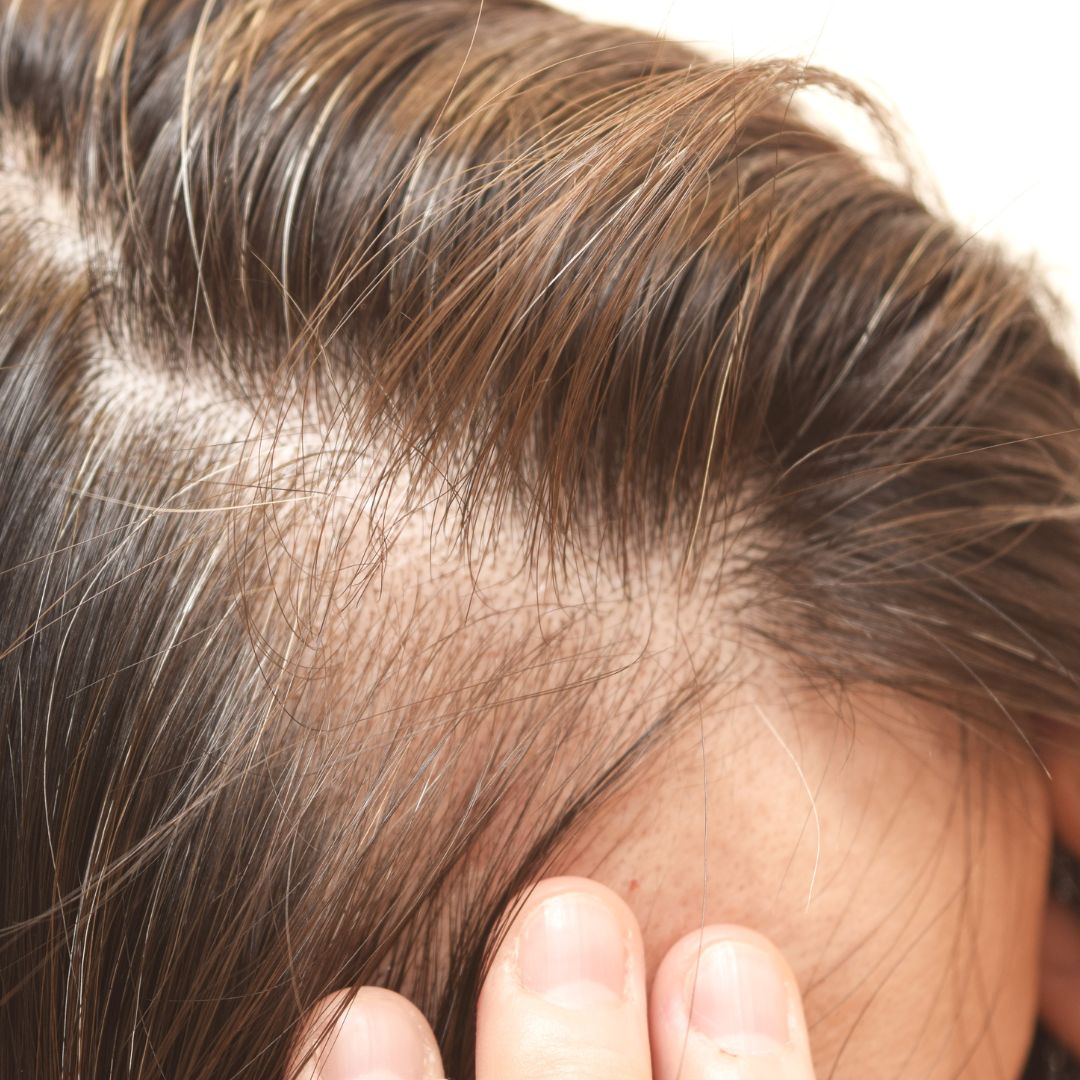 The Real Causes of Hair Loss