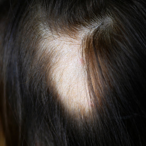 A photo of a woman's patchy hair loss.