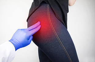 Piriformis-Syndrom bildlich dargestellt