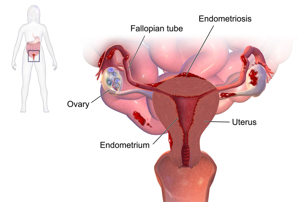 Endometriosis