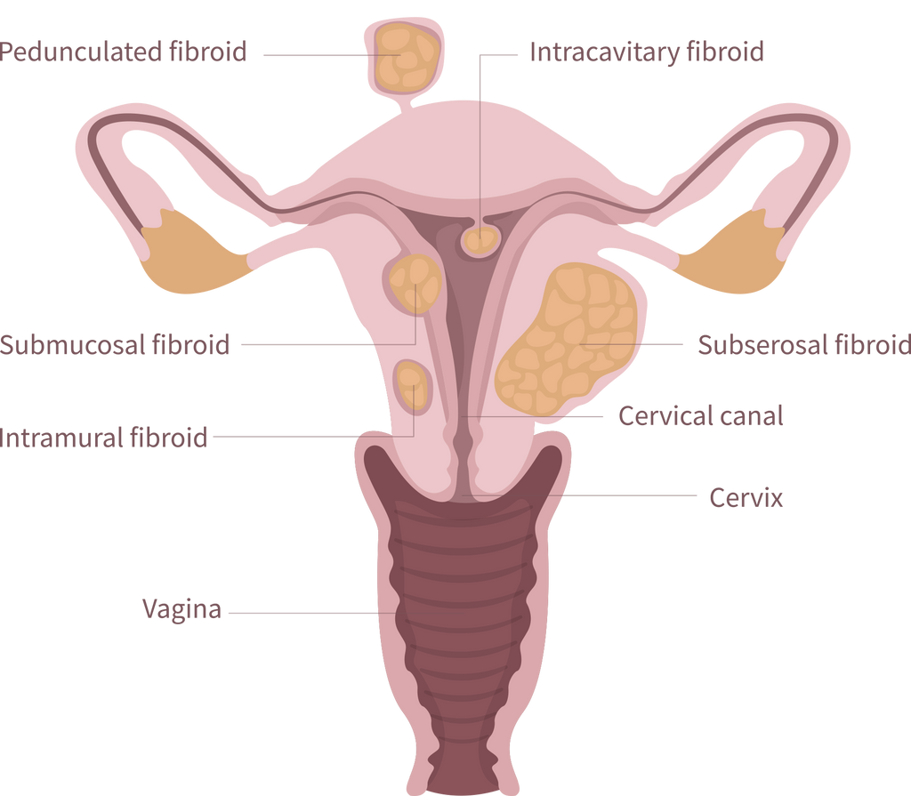 Uterine Fibroids – Semaine Health