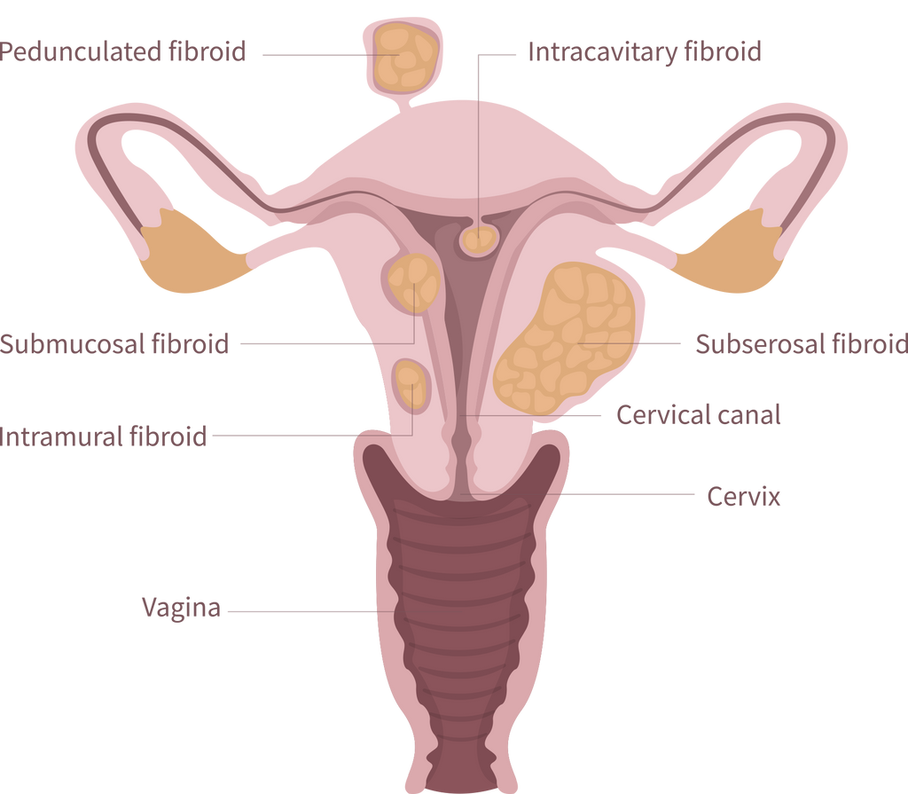 Uterine fibroids