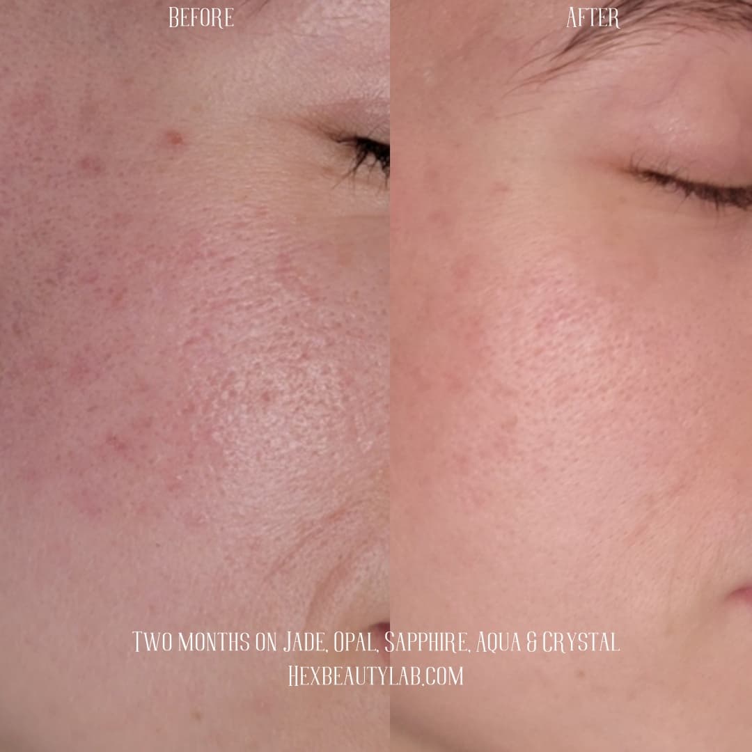 acne scar cure skincare for texture pores results transformation