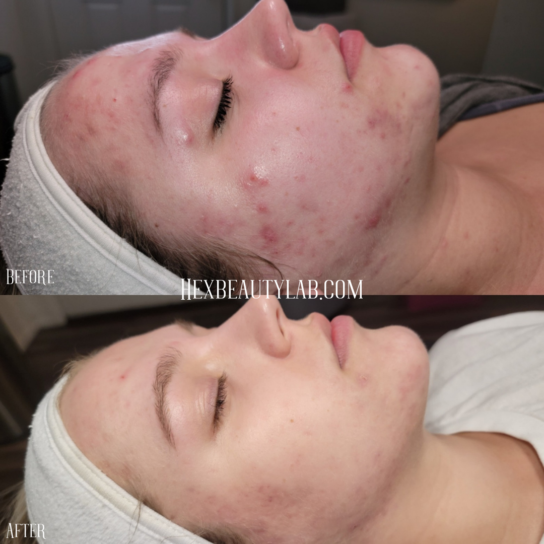 acne skincare transformation before and after photo blemish Accutane derm dermatology medical skincare results  