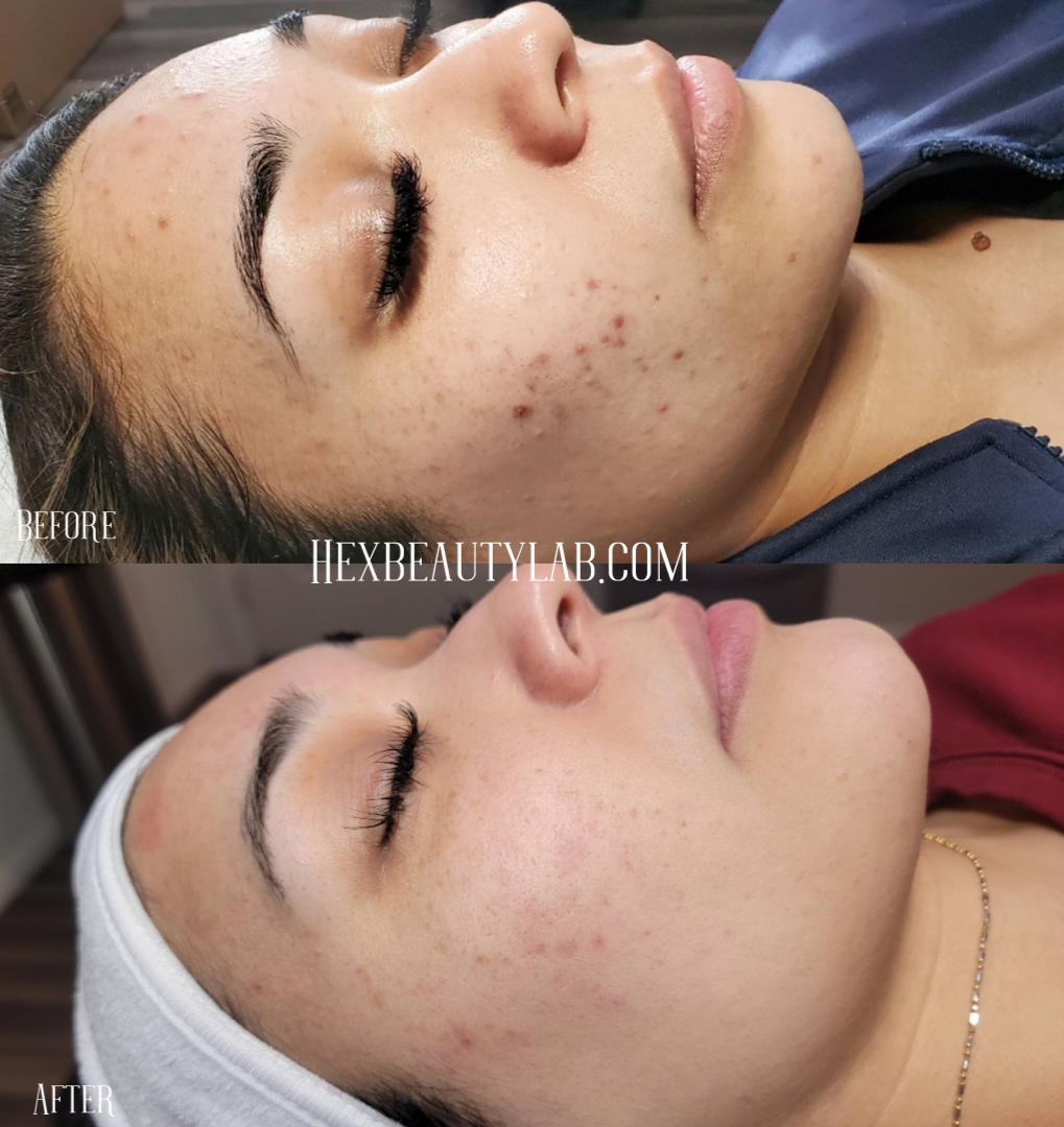 skincare transformation acne scar scars texture blemish before and after hex beauty lab 