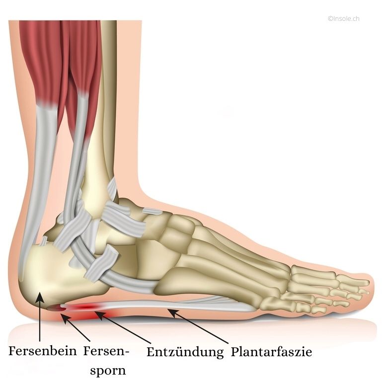 Fersensporn Plantarfasziitis Behandlung