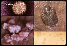 Genital Warts (HPV) â€“ Condom-USA