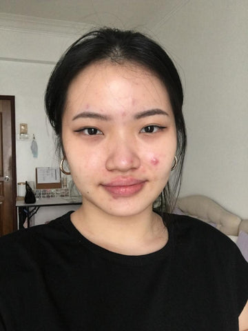acne-skin-journey