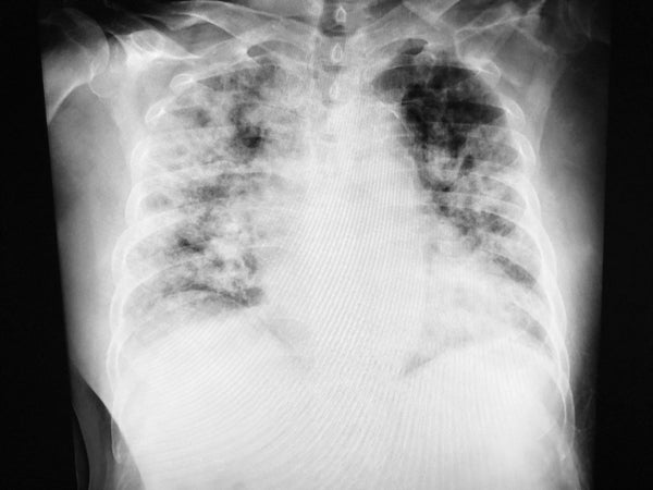 ground glass opacities in the lung on x-ray