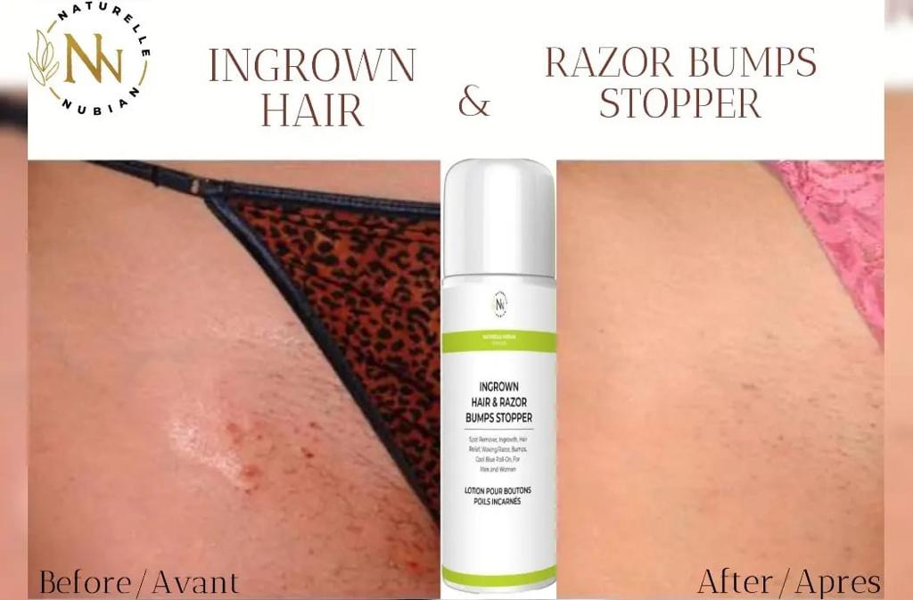 5 Ways to Get Rid of Ingrown Hair or Razor Bumps