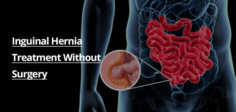 The Five Best Ways To Manage An Inguinal Hernia Witho