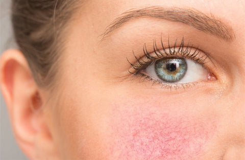 Rosacea is a skin condition characterized by the expansion of small, superficial vessels of the face, which may lead to bumps that look a bit like acne.