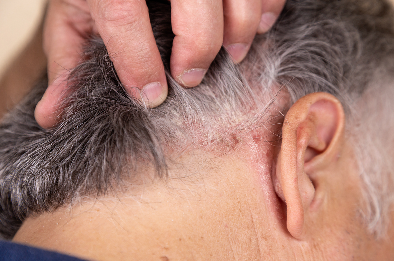 4 Common Itchy Scalp Causes  How To Treat It