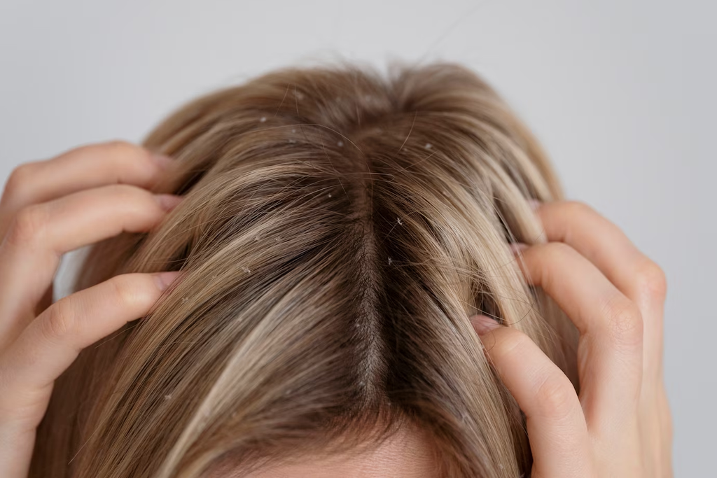 woman scratching head with dandruff
