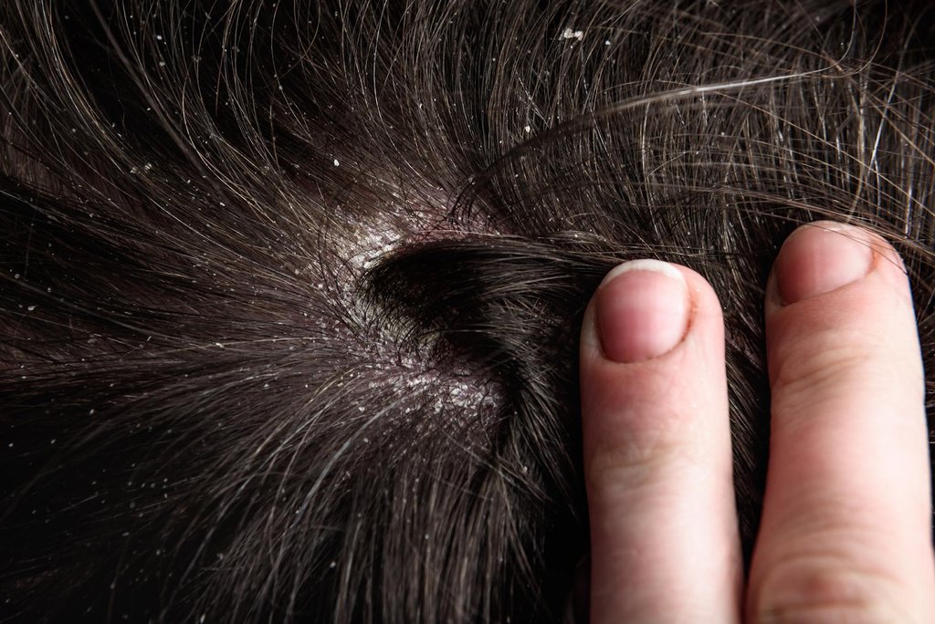 dandruff on scalp