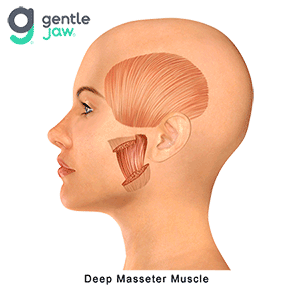 Deep masseter referred muscle pain pattern into the TMJ