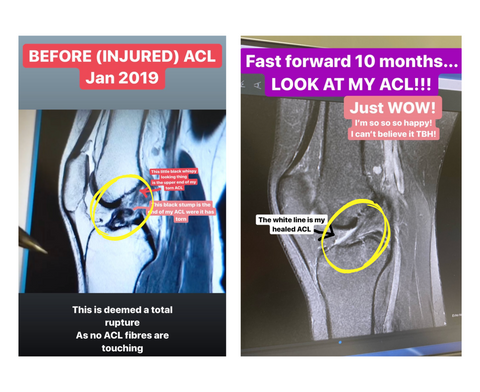 ACL Tear