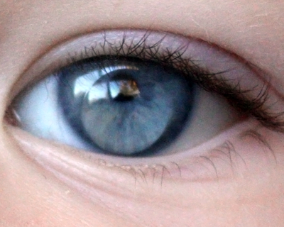 Eye with Aphakic Contact Lens