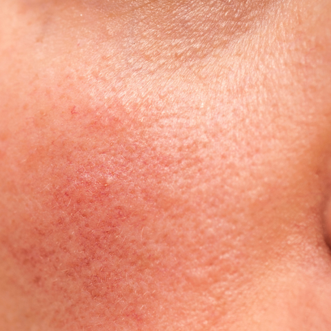 Rosacea huid