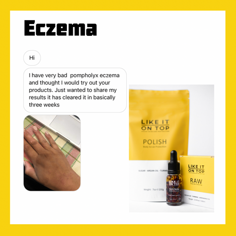 eczema skincare with natural ingredients