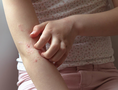 treatment for eczema on the body