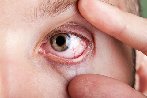 Eye disease.