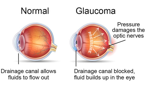 A chart of how Glaucoma works.