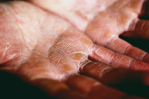 dry skin on hands