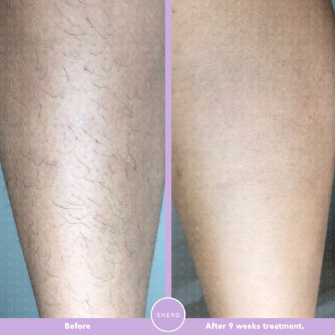 IPL Hair Removal Results Before and After 9 Weeks