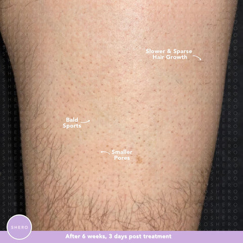 IPL Hair Removal Results For Men After 6 Weeks